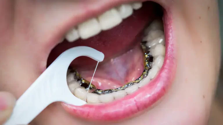 What are Lingual Braces?