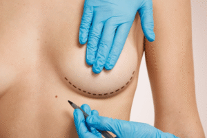 Breast Lift